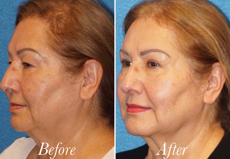 Face Before and After Patient 4