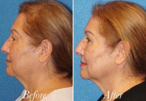 Face Before and After Patient Thumbnail 5