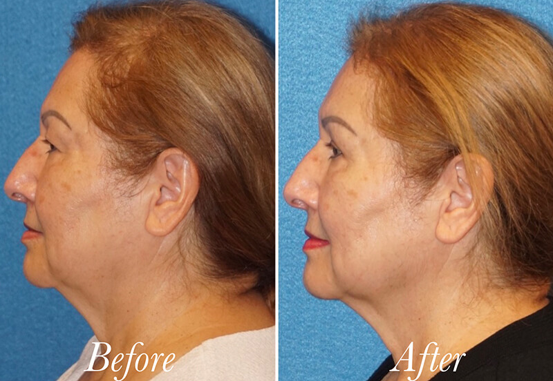 Face Before and After Patient 5