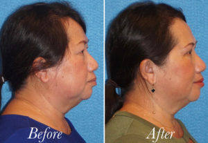 Face Before and After Patient Thumbnail 2