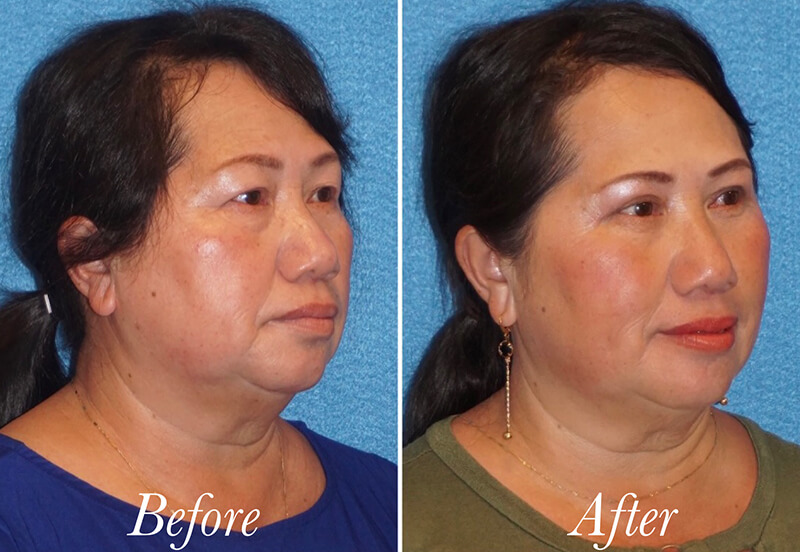 Face Before and After Patient 3