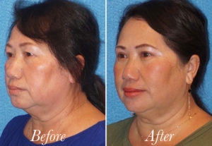 Face Before and After Patient Thumbnail 4