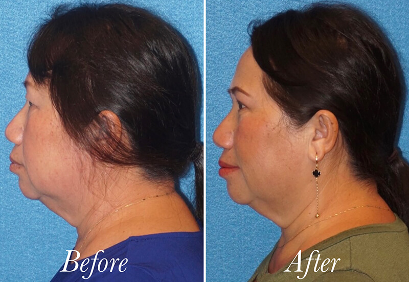 Face Before and After Patient 5