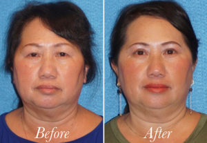 Face Before and After Patient Thumbnail 1