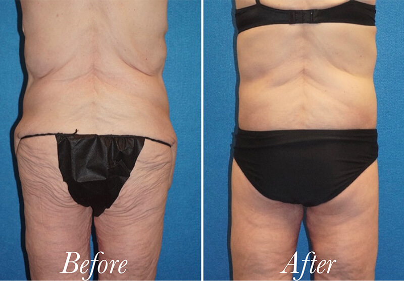 Body Before and After Patient 2