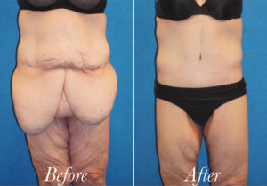 Body Before and After Patient Thumbnail 1