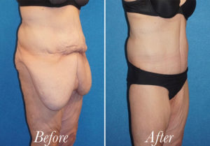 Body Before and After Patient Thumbnail 3