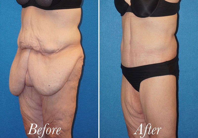 Body Before and After Patient 4