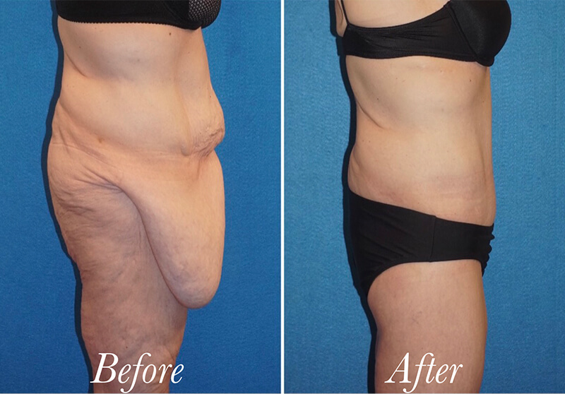 Body Before and After Patient 5