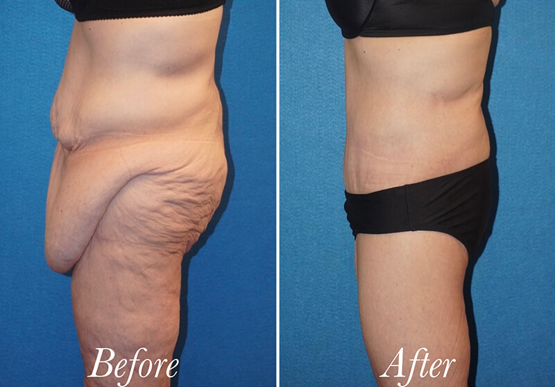 Body Before and After Patient 6